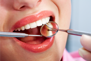 Dental Restoration