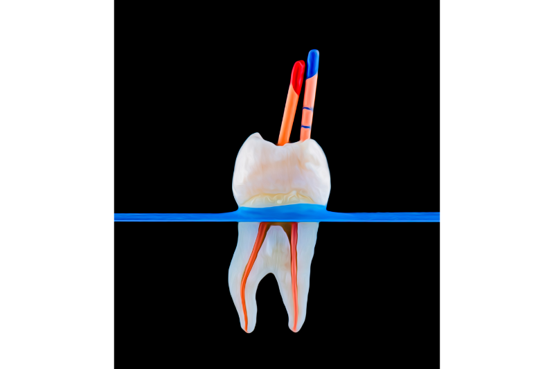 The Basic in Endodontics Step by Step